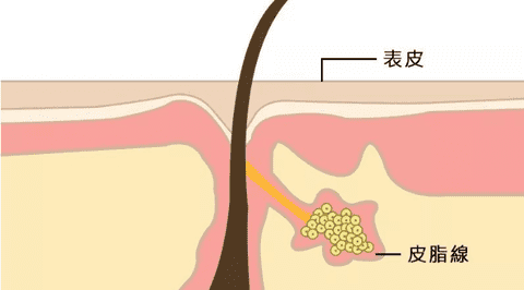 10羥基癸酸抗痘皮脂抑制